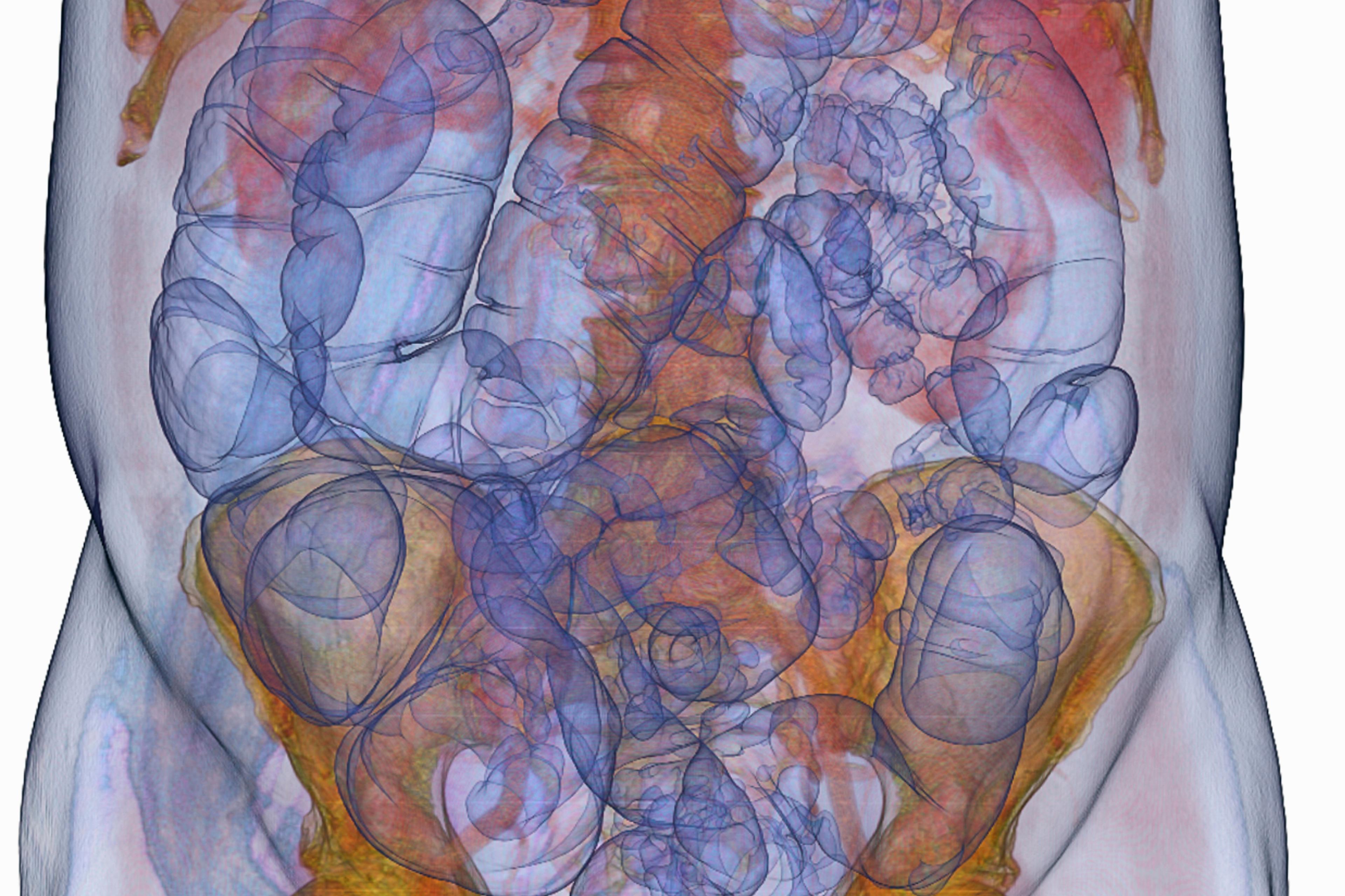 Coloured medical scan of human abdomen showing internal organs with blue and orange highlights, digital imaging.