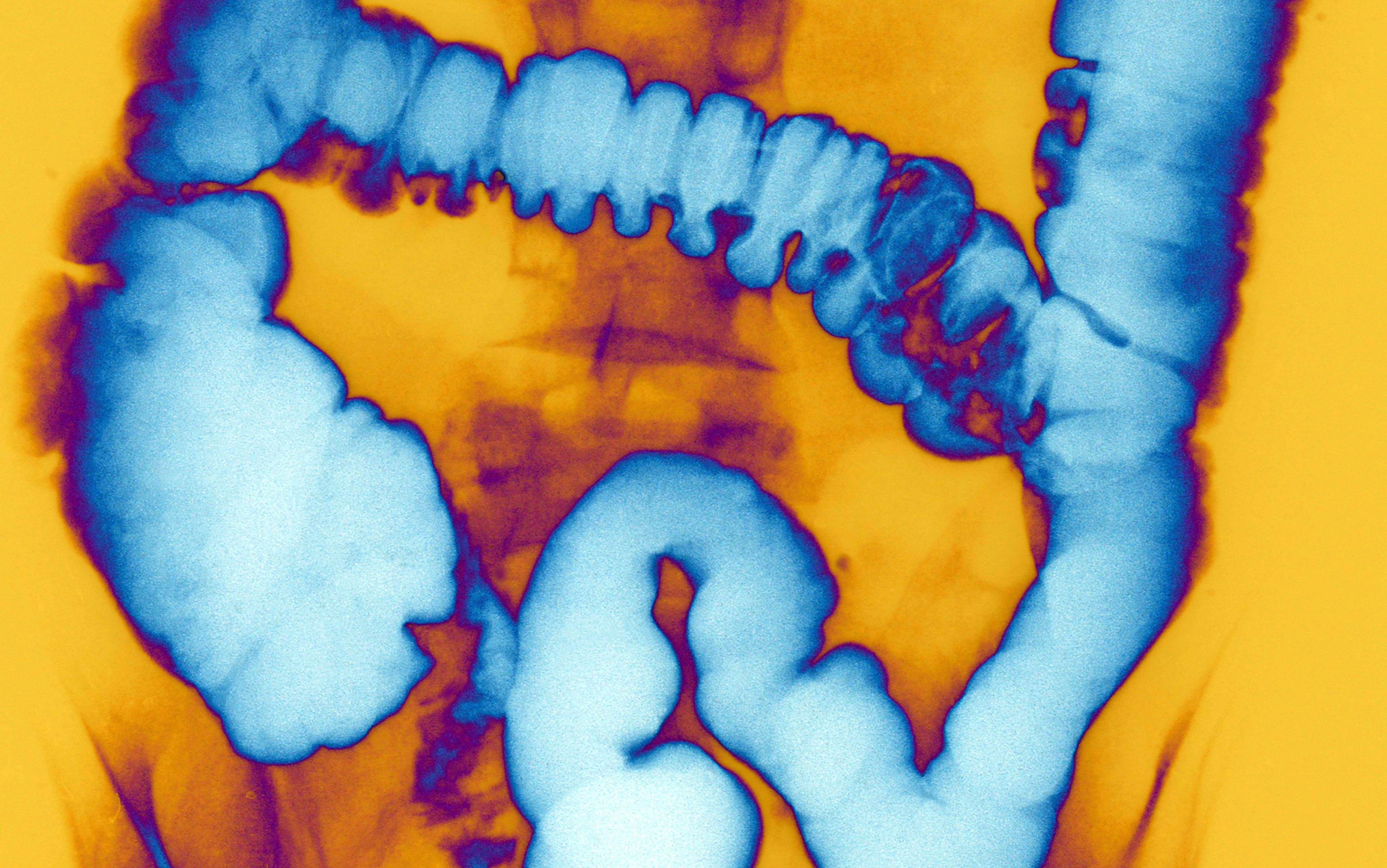 Image of a human colon highlighted in blue, with a contrasting yellow-orange background, taken using a medical imaging technique to show the internal structure.