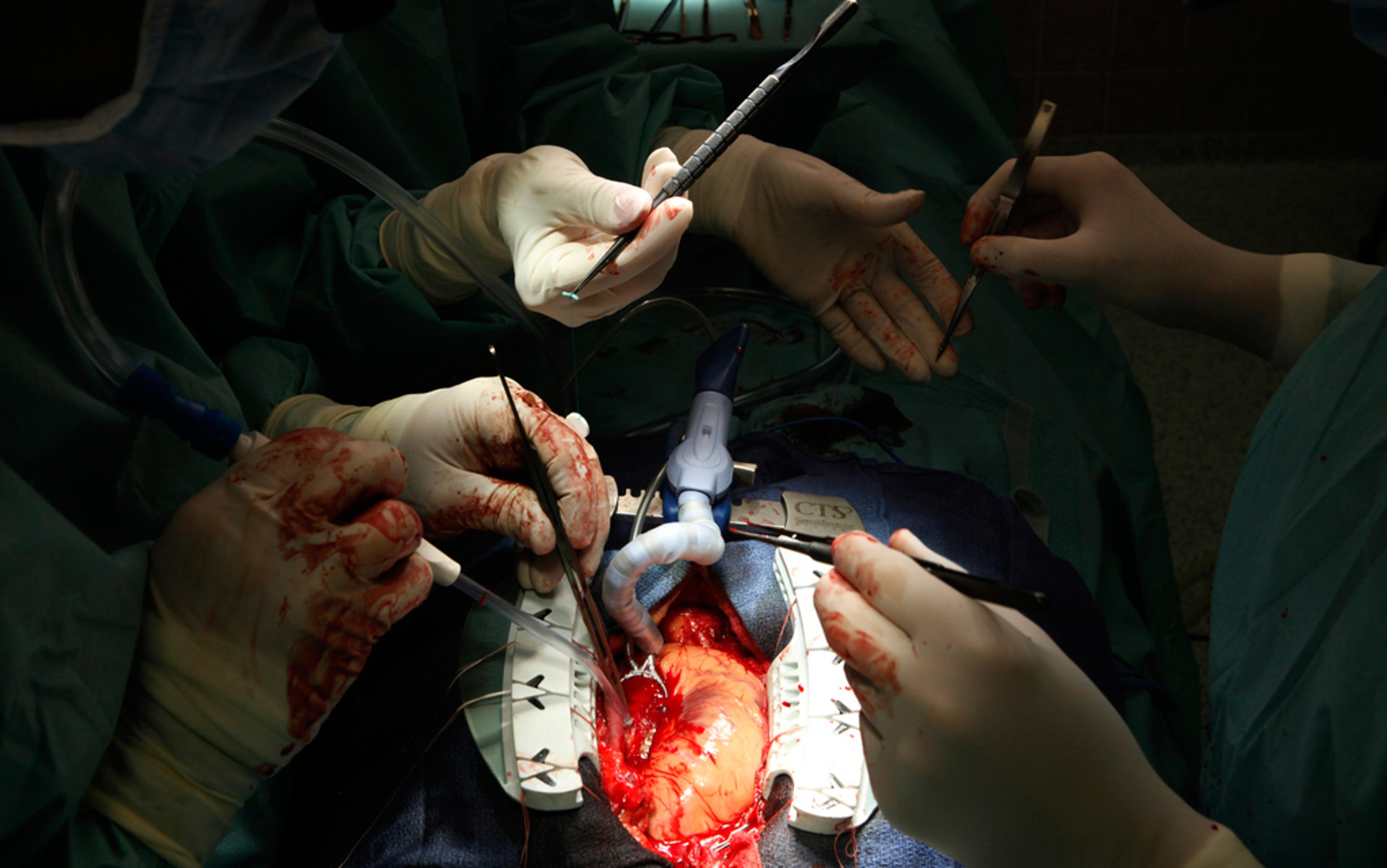 Surgeons performing open-heart surgery with several hands visible, using medical instruments on an exposed heart.