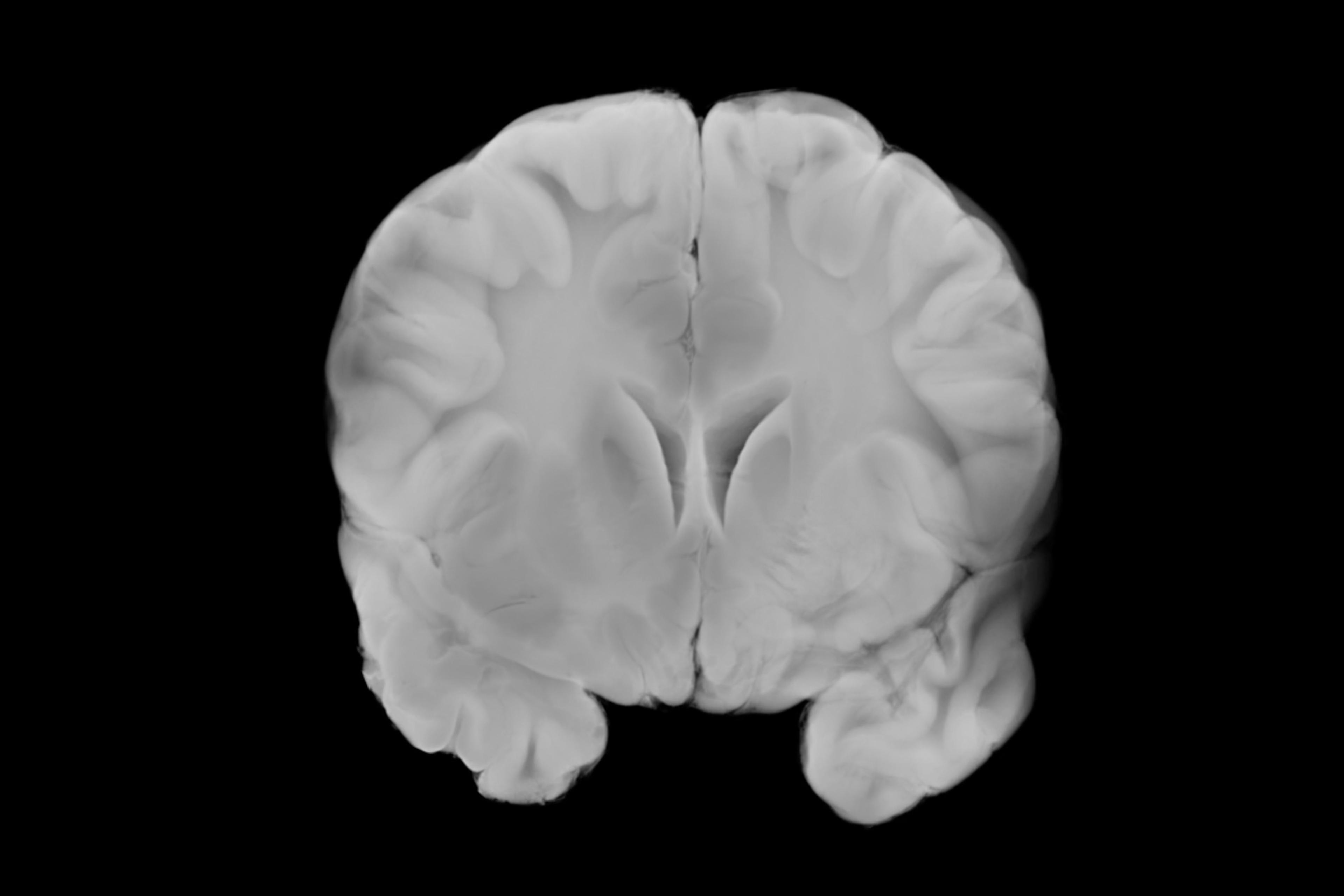 MRI scan of a human brain in greyscale showing detailed brain structures on a black background.