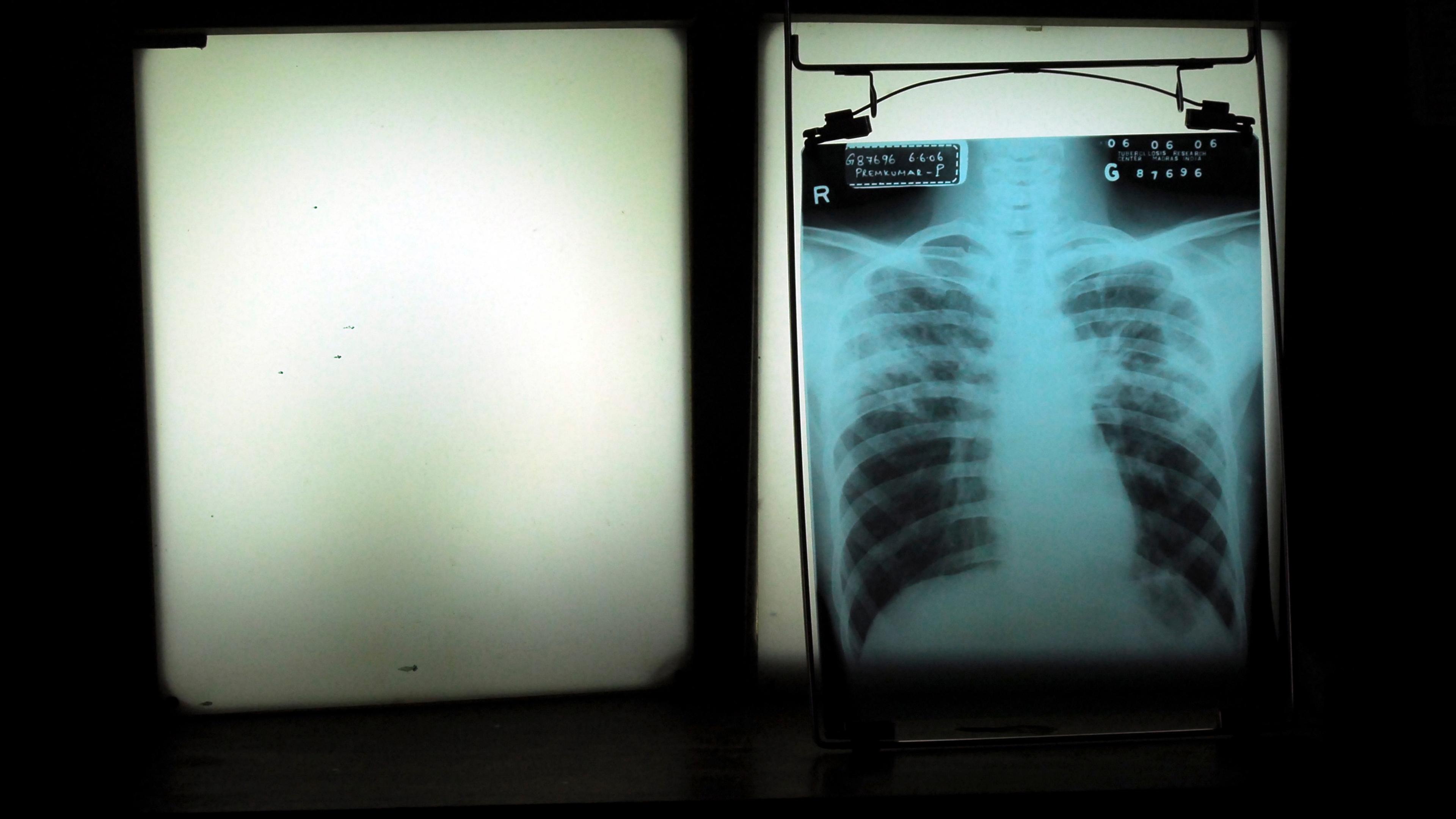 Photo of an X-ray on a lightbox showing a human chest in a dark room with a blank lightbox beside it.