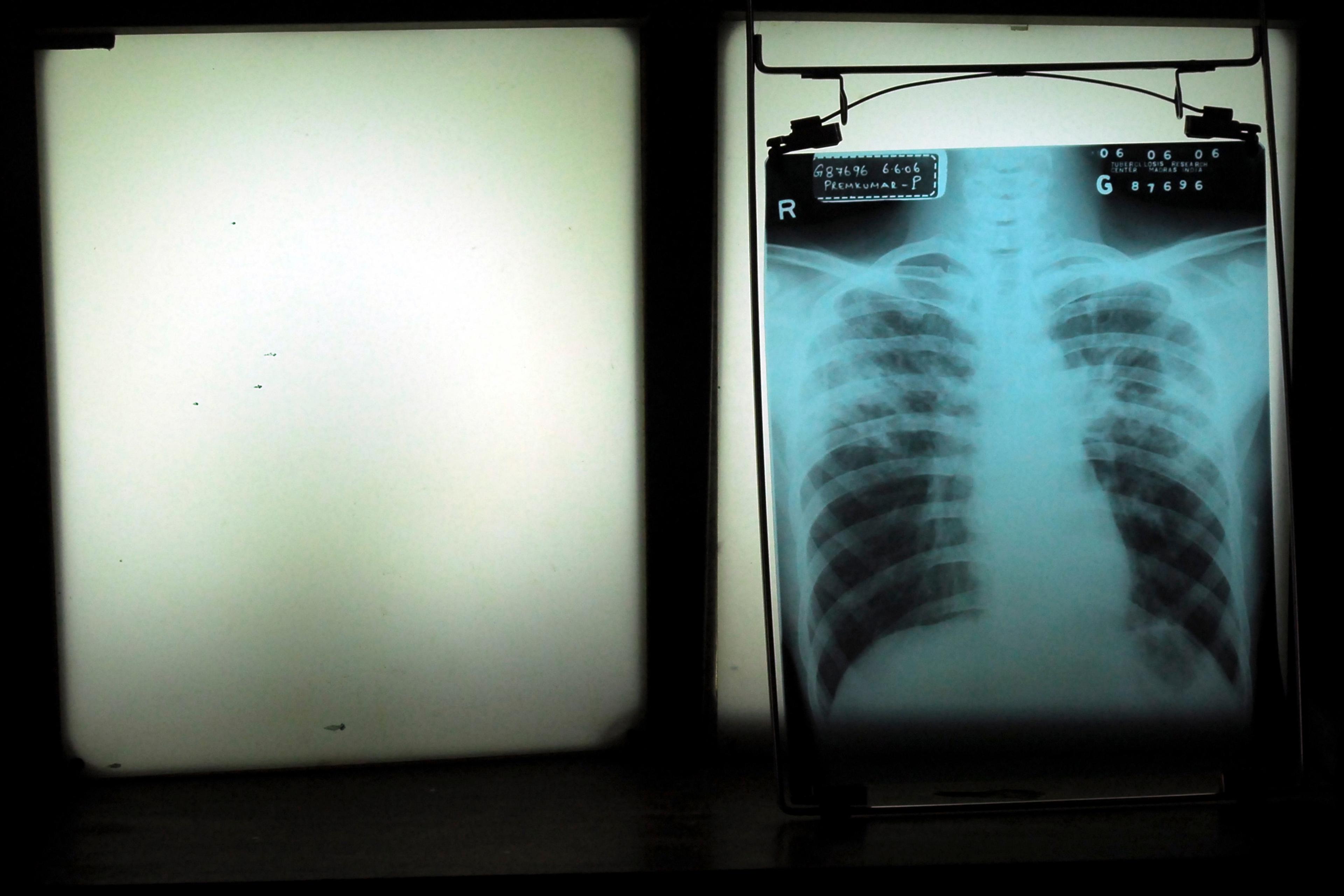Photo of an X-ray on a lightbox showing a human chest in a dark room with a blank lightbox beside it.