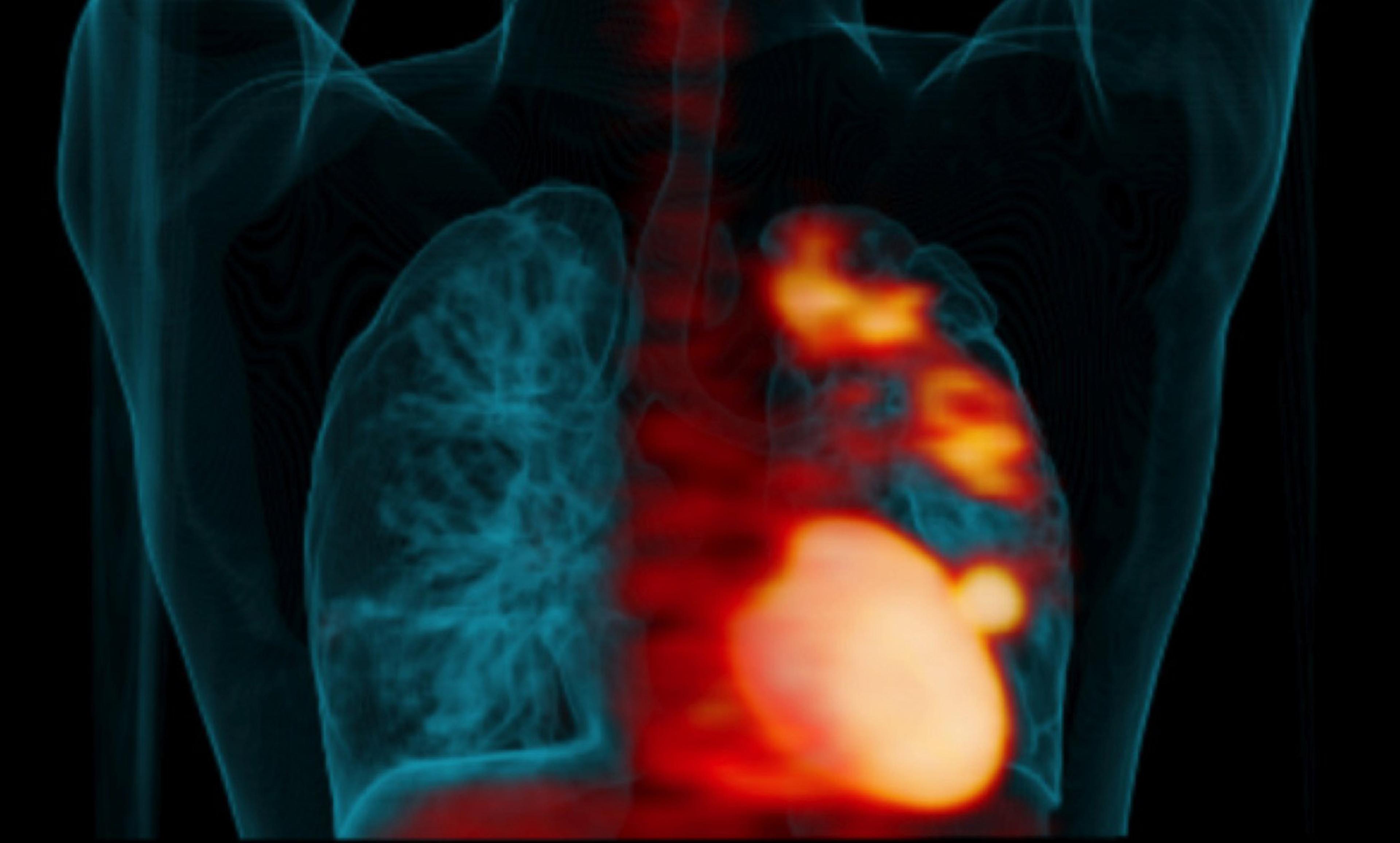 <p>Lung scan showing ‘hot spots’ of TB infection<em>. Photo courtesy UPMC Pittsburgh</em></p>