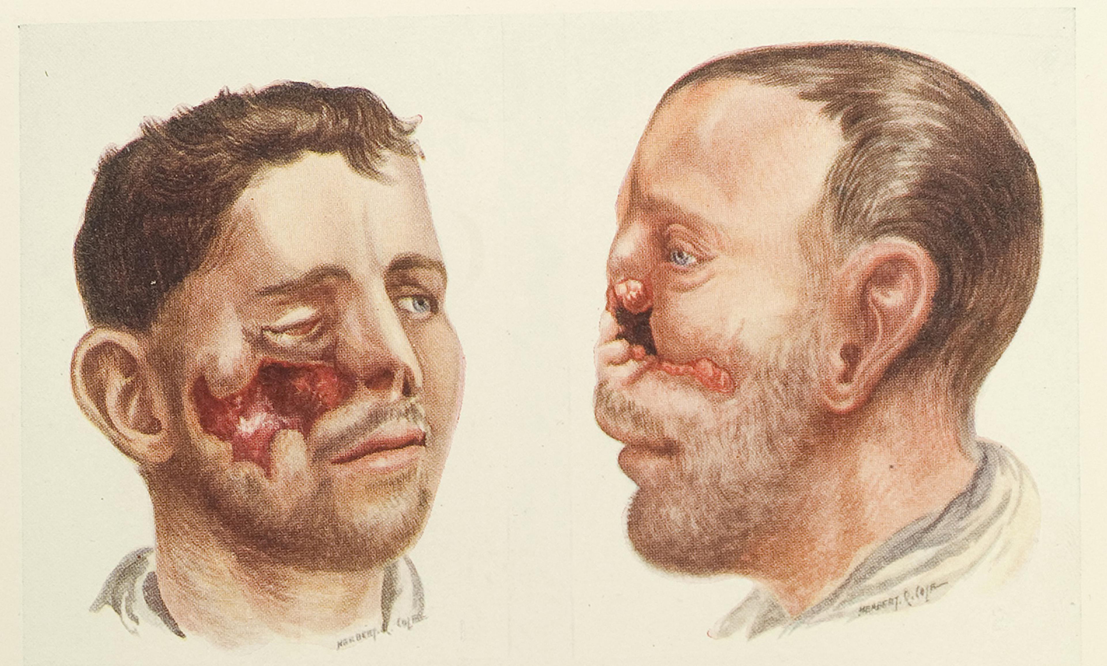 Medical illustration showing facial injuries on two men, left face with open wound on cheek, right profile with severe nasal damage.