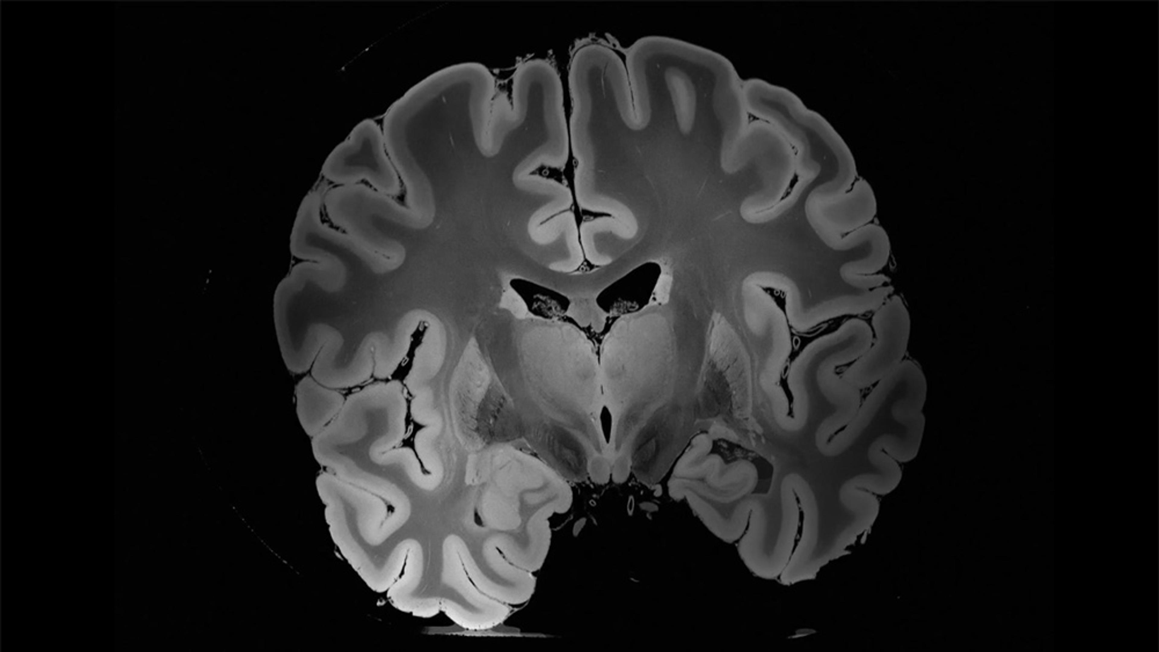 MRI scan of a human brain section, showing detailed anatomical structures in greyscale against a black background.