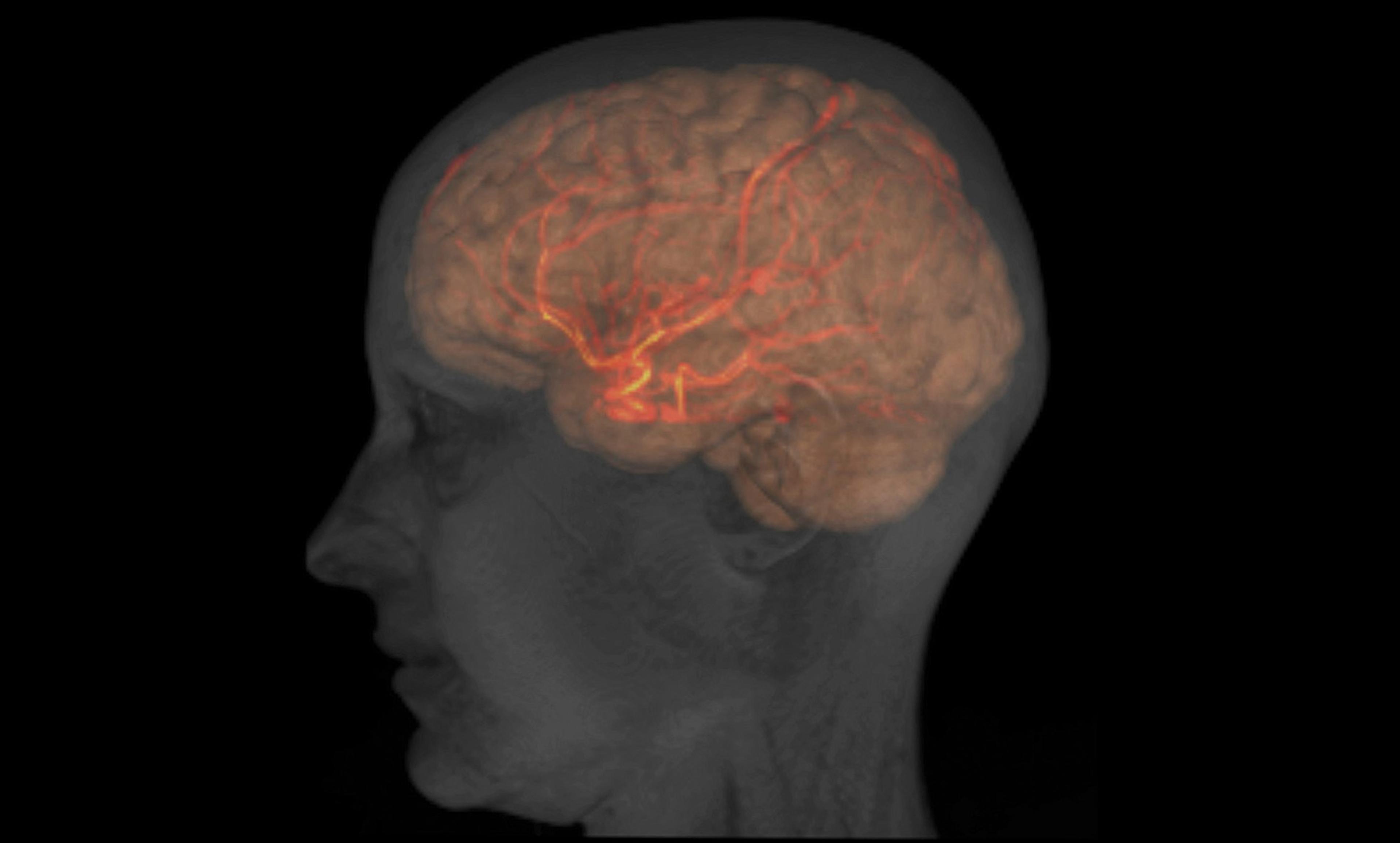 <p>MRI image of the head, brain and large arteries of a healthy female adult. <em>Courtesy Patrick Hales, UCL/Wellcome Institute</em></p>