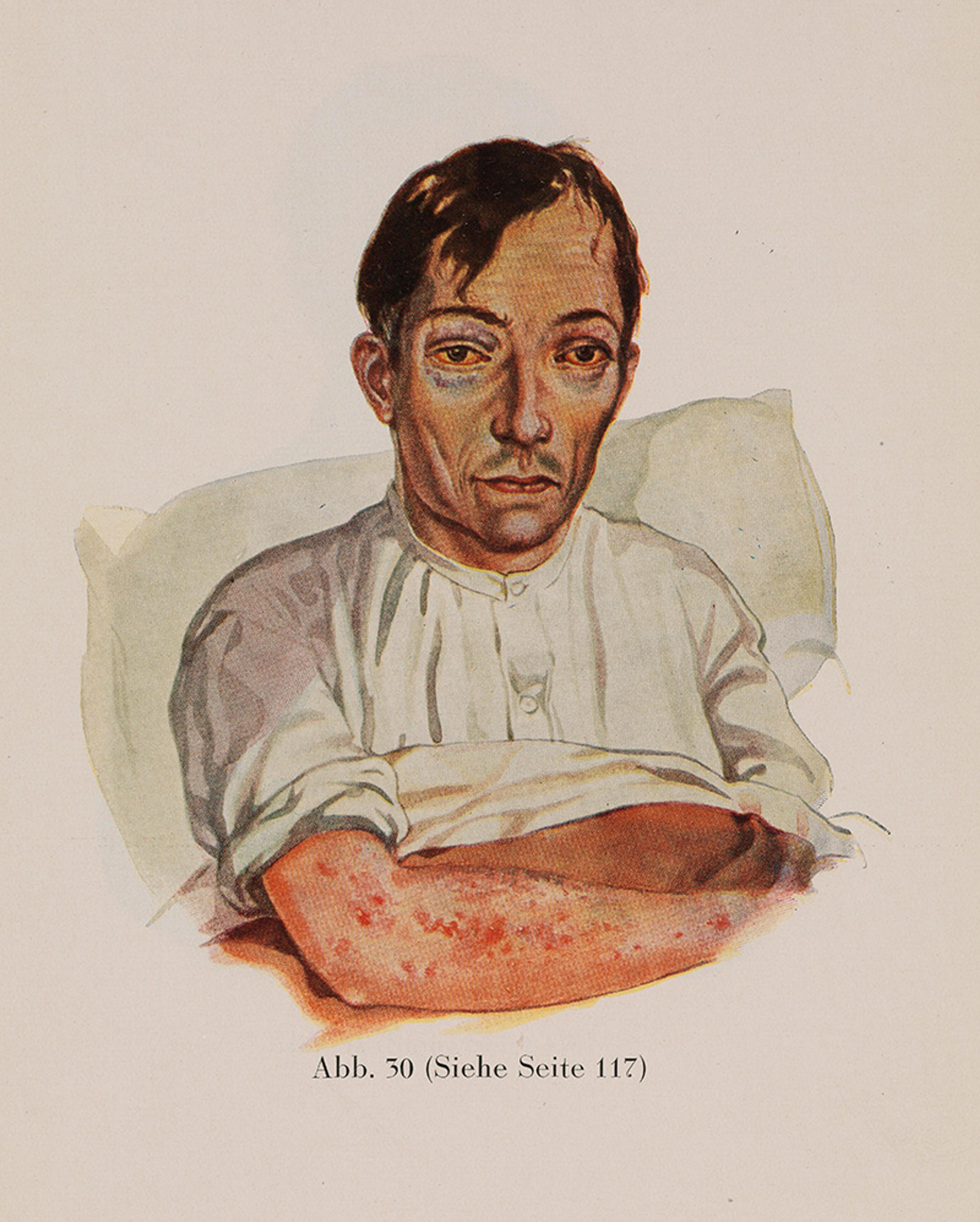 Painting of a man in a white shirt lying on a pillow, with a tired expression and skin lesions on his arm. Caption in German below.