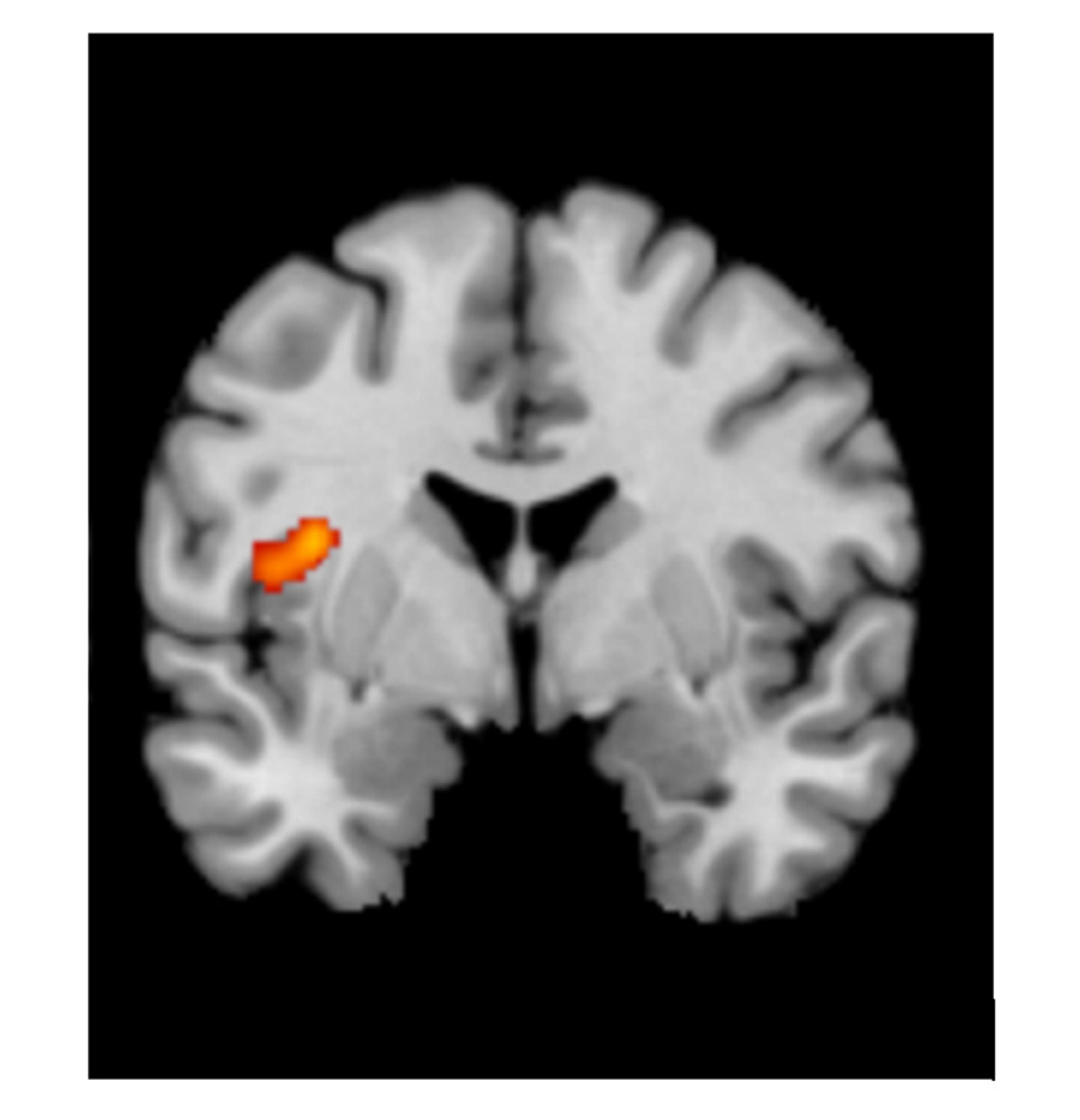 MRI brain scan with a highlighted area in the left hemisphere showing brain activity, against a black background.