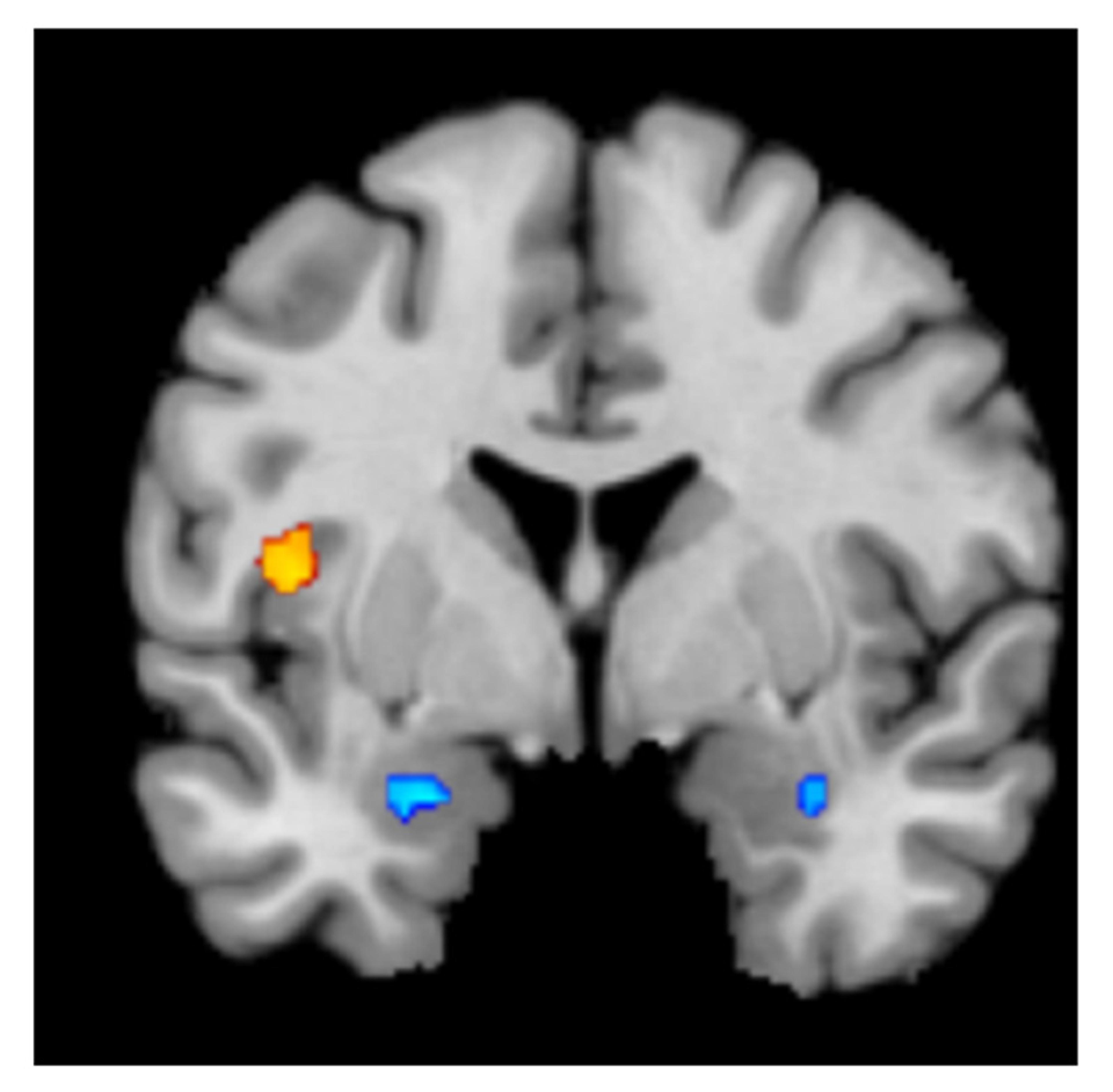 MRI scan of a brain highlighting regions with coloured areas, showing activated brain regions in orange and blue.