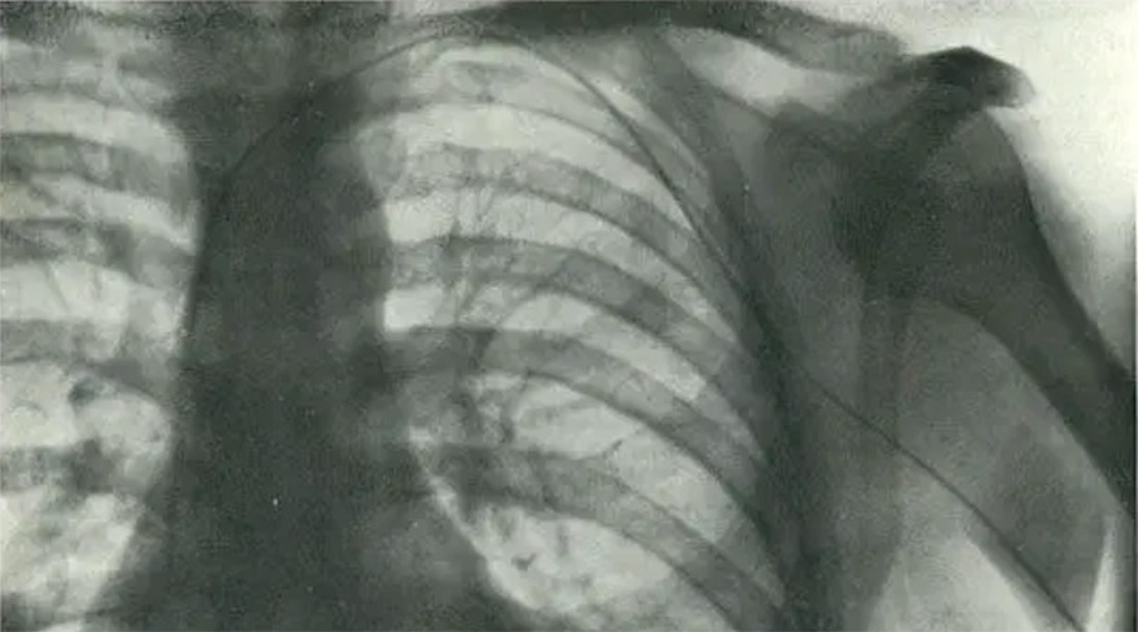 An X-ray image showing a close-up view of the chest with visible ribs and parts of the shoulder bones.
