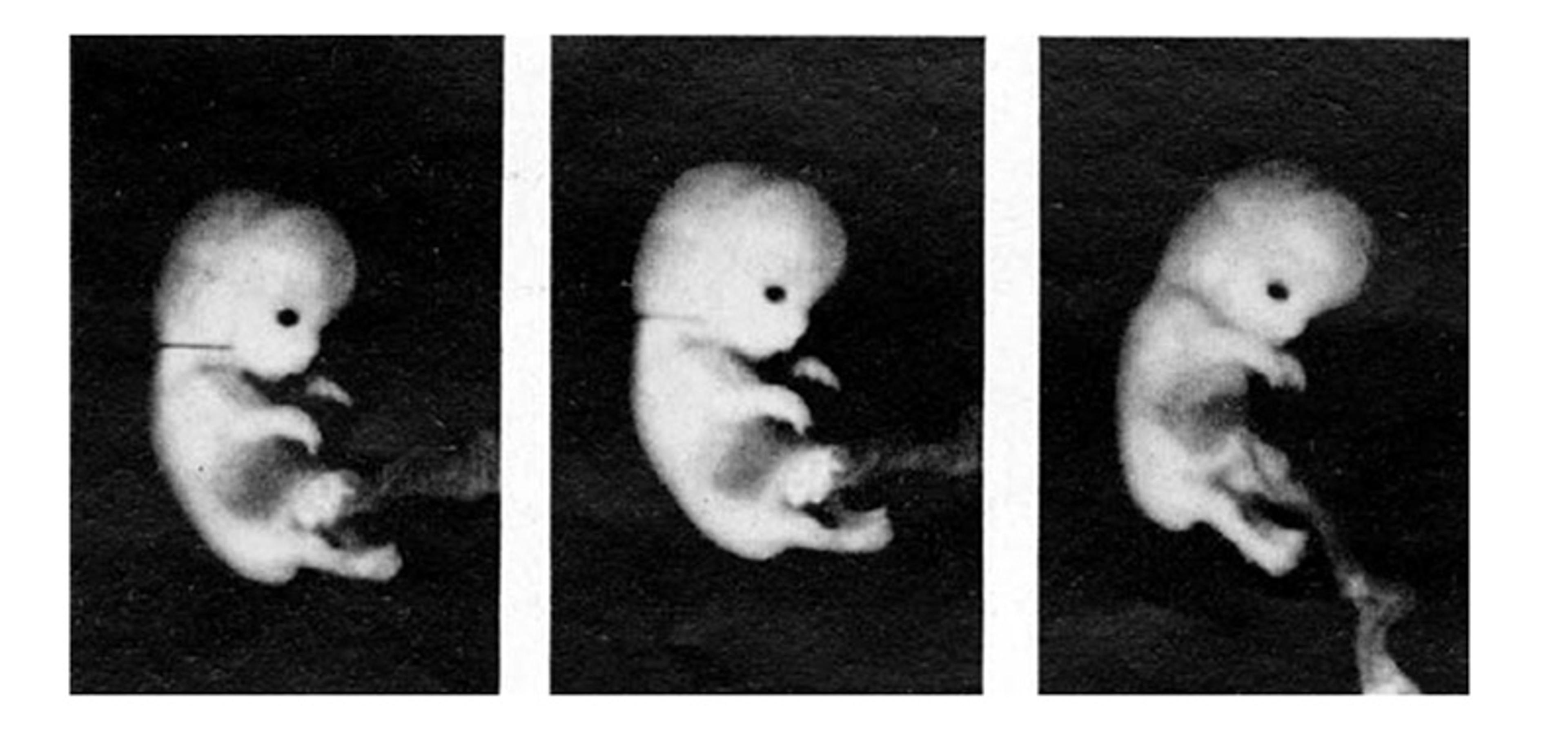 Three black and white images of a fetus in different stages of development shown side by side against a dark background.